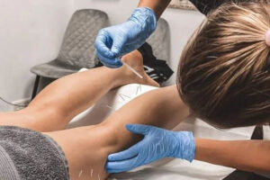 dry-needling suche igłowanie Zielona Góra