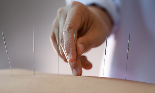 terapia suche igłowanie Zielona Góra